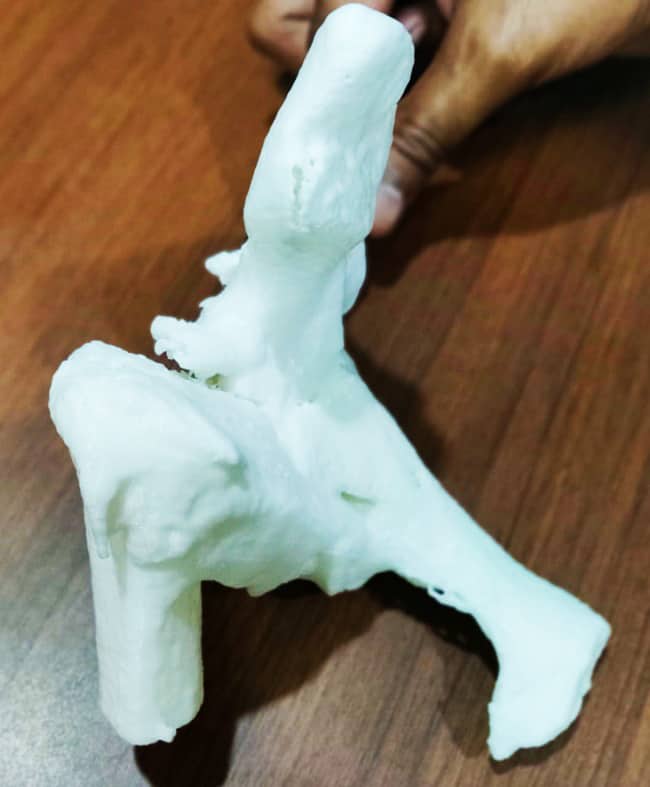 A 3D Printed Hip Model. Image - Aster RV Hospital