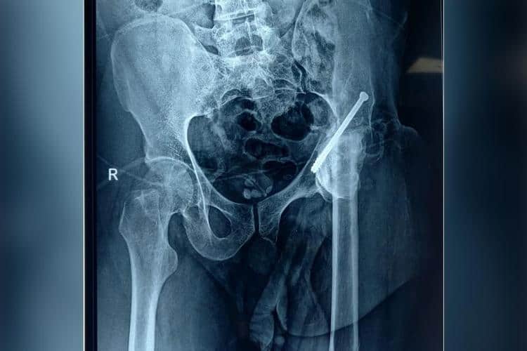 An X-Ray of Kasim's hip. Image - Aster RV Hospital