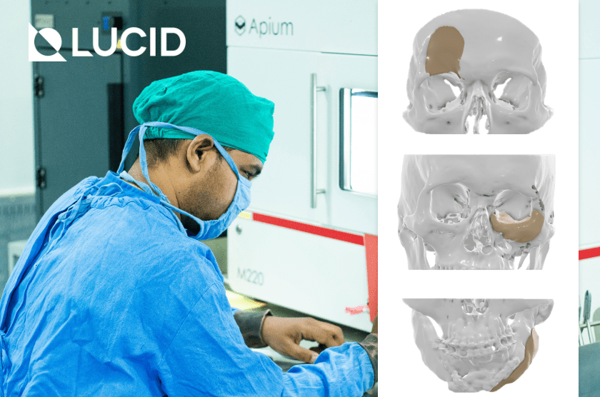 Bringing Life to Near Normal - Lucid Implants, a medical additive manufacturing company changing the face of medical implants