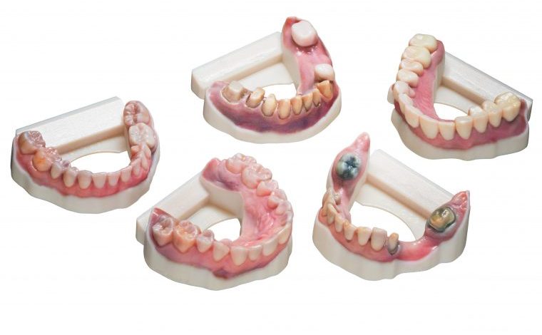 Using an intraoral scanner, 3Shape’s software and the Stratasys J5 DentaJet™ 3D printer, dental labs are now able to produce extremely accurate personalized full-color dental models. Models courtesy of Smile Designs By Rego