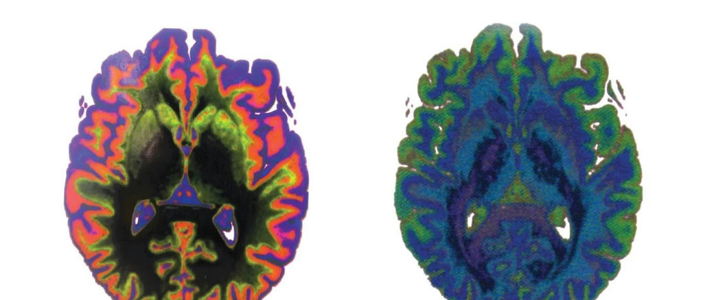 Digital representations of a human brain created using a technique developed by researchers at CU Boulder and the CU Anschutz Medical Campus. (Credit: Jacobson, et al., 2022, 3D Printing and Additive Manufacturing; CC-BY 4.0)
